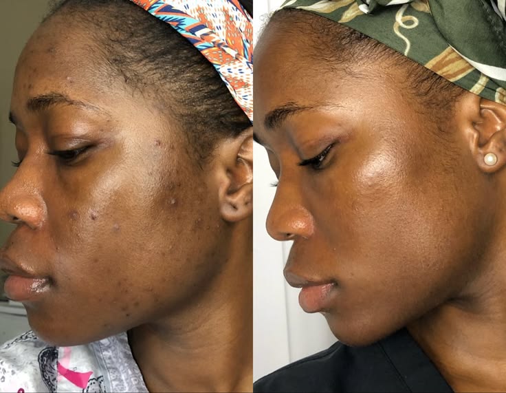 Real ZURIÉ customer before and after showing visibly clearer, more even-toned skin with reduced acne marks