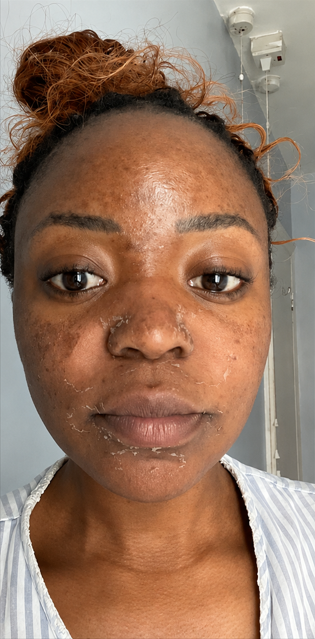Skin before treatment — uneven tone with visible dark spots